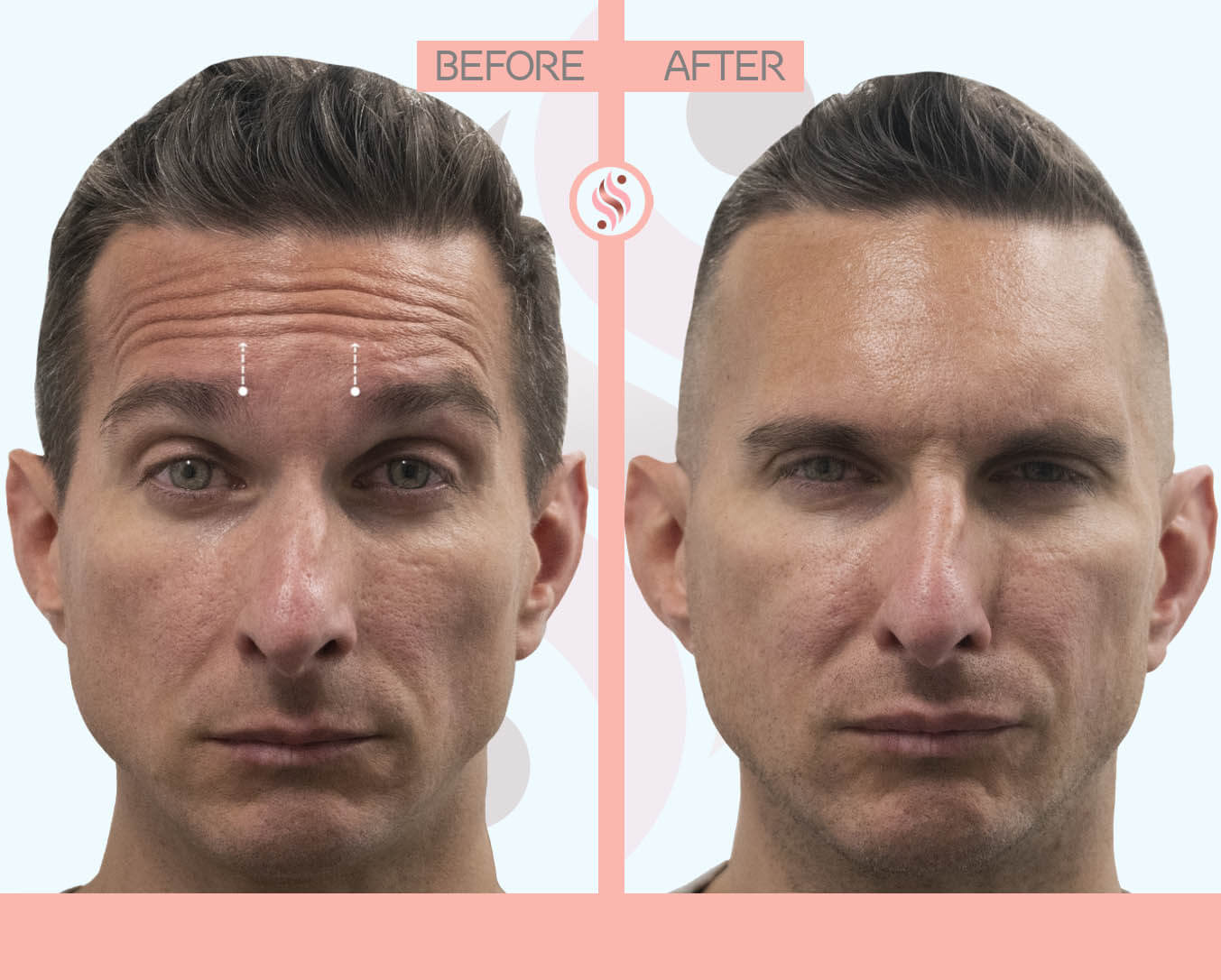 men horizontal lines injection - before and after