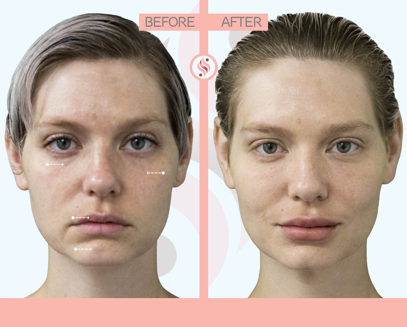 tear trough, cheeks and smile lines injection - before and after