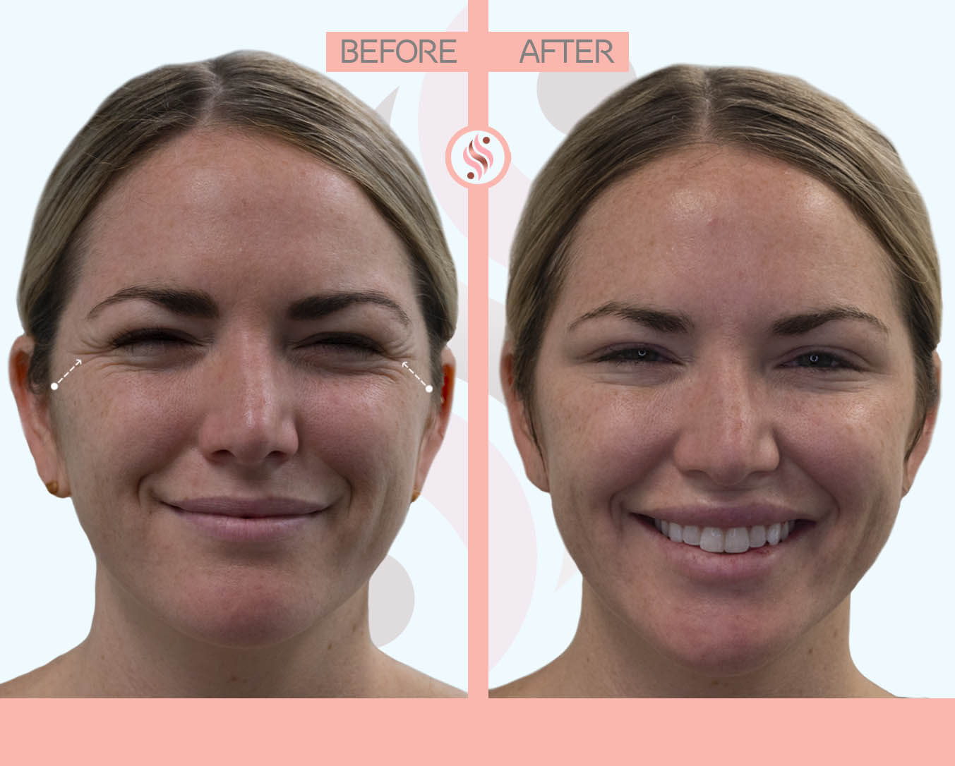 crow's feet filler - before and after