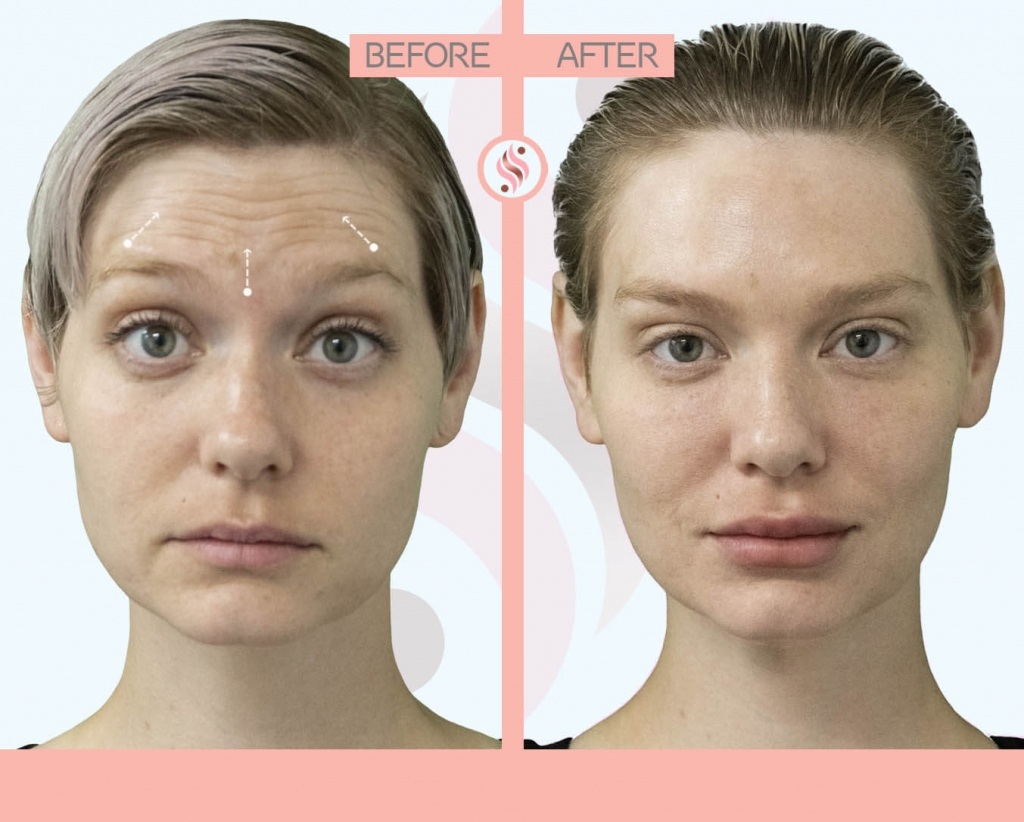 botox-before-after-photo