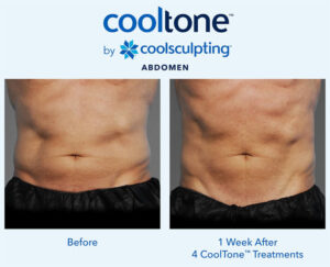 cooltone before after