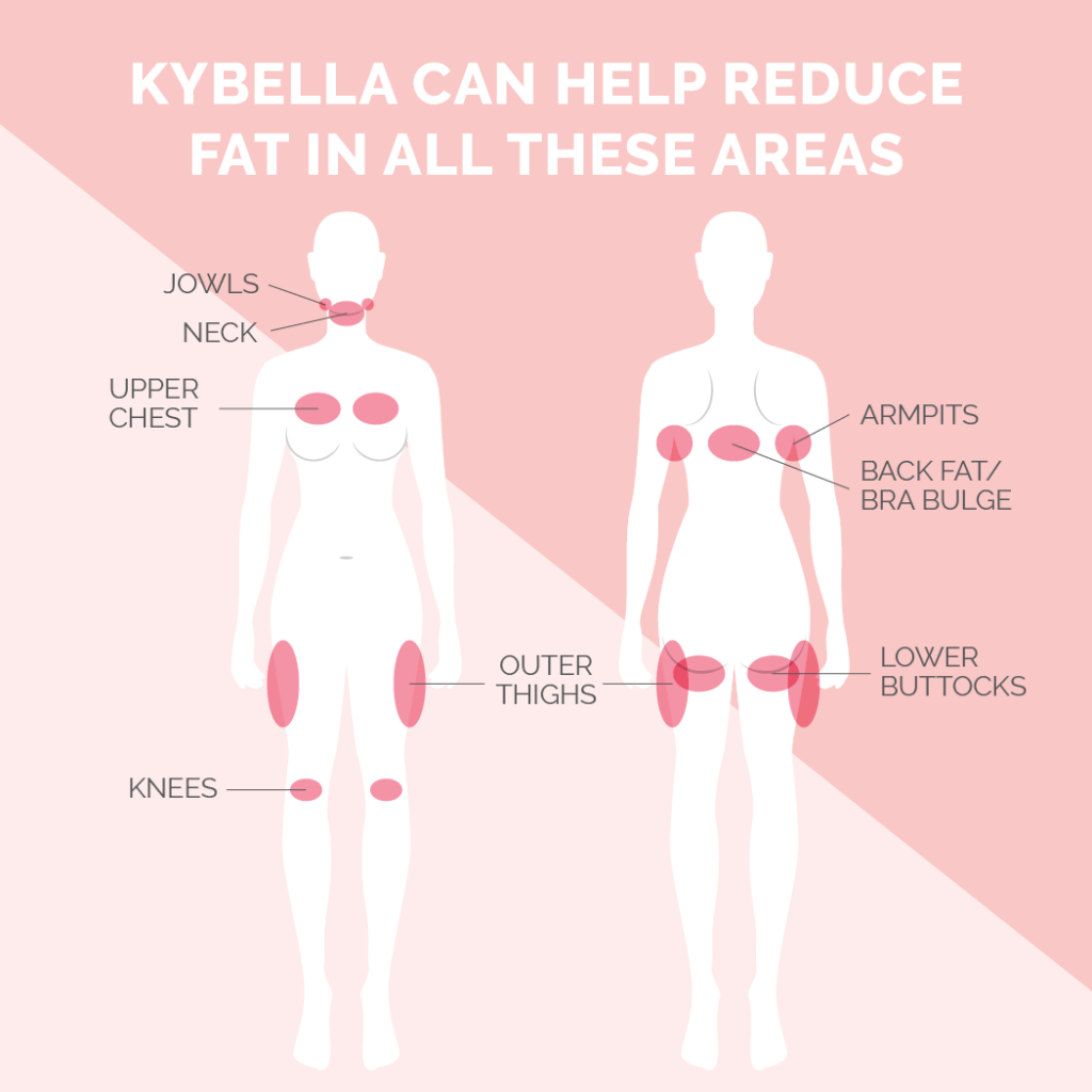 Kybella Treatment Areas Graphic