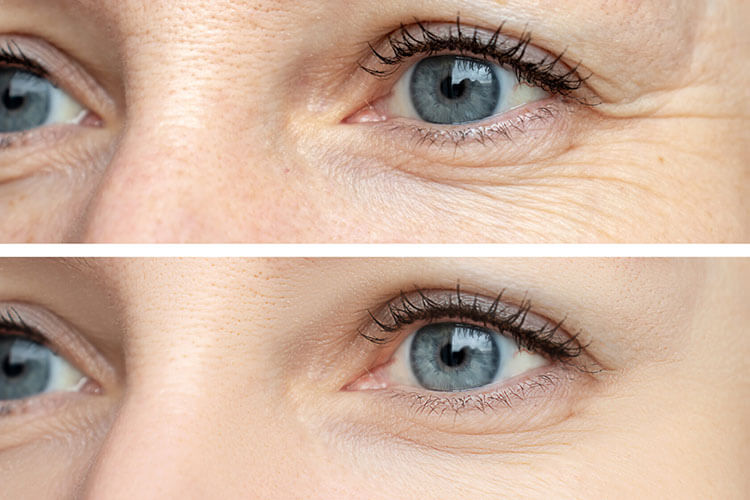 Botox crows feet - before and after