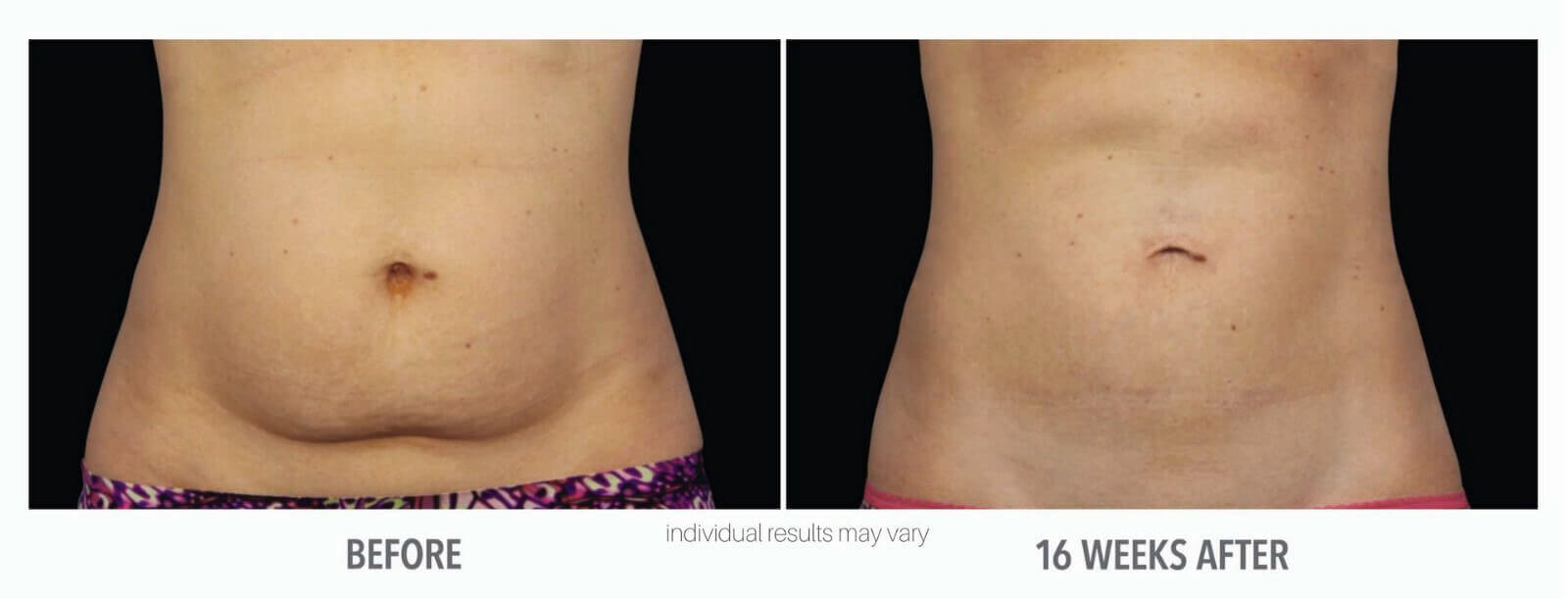 Coolsculpting stomach before after
