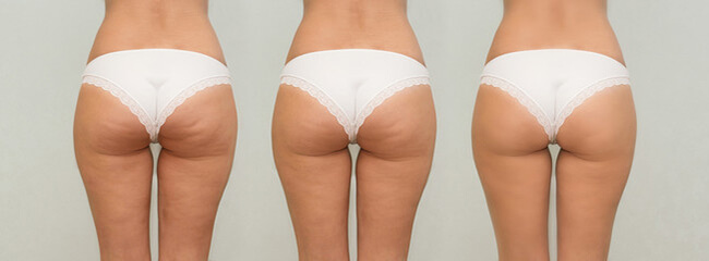 Coolsculpting cellulite treatment
