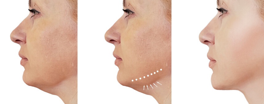 Get rid of double chin | before - midtreatment - after