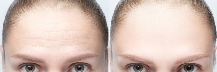 Forehead wrinkles before and after
