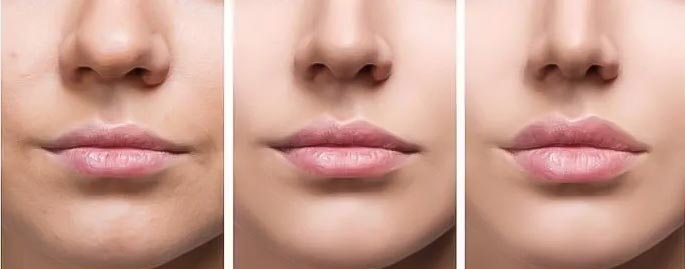 Lip fillers after 1 week and 3 weeks