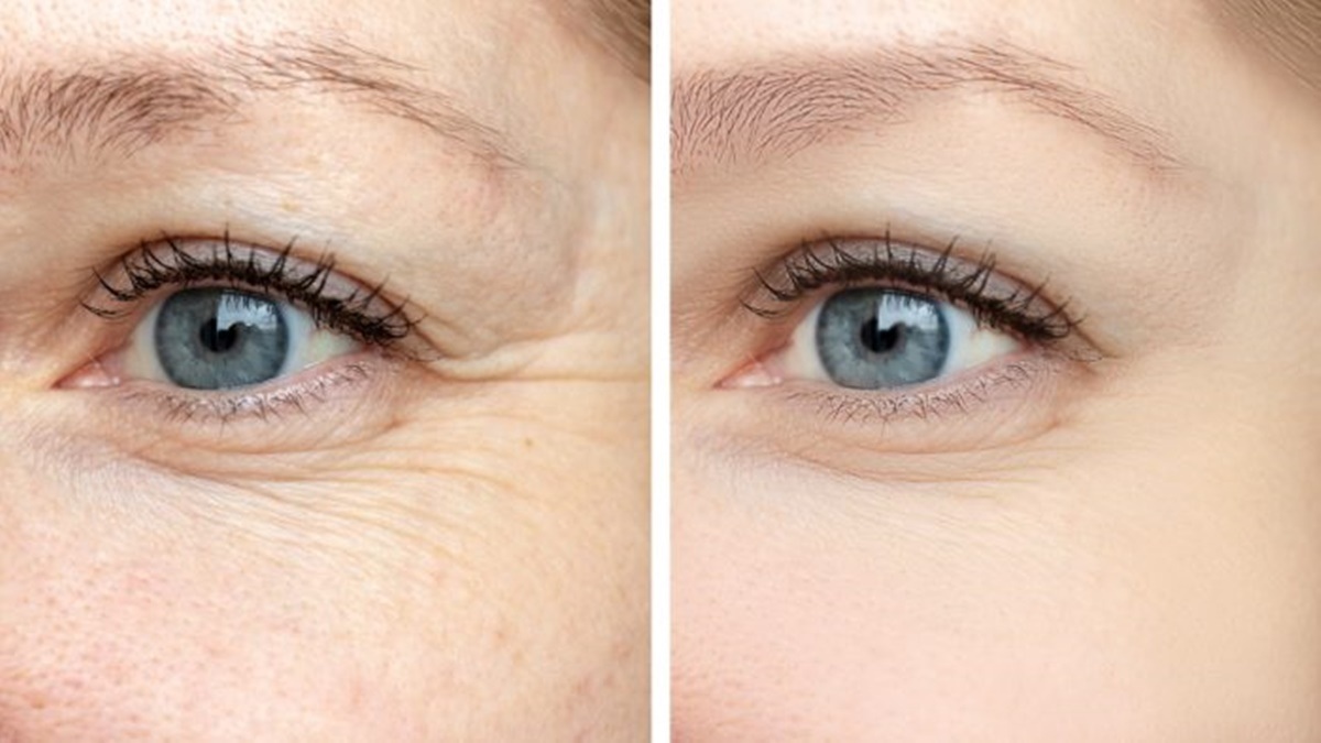Are Facial Fillers helping with dark under eye circles