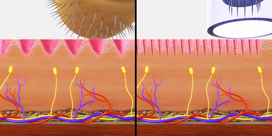 Dermapen vs DIY Dermarolling microneedling