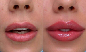 Russian lip augmentation