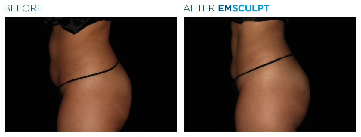 Emsculpt neo before after