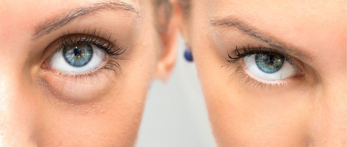 Restylane under eye filler