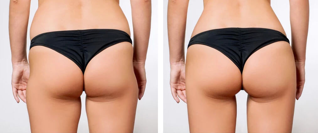 Sculptra butt lift | Natural result | Before and after
