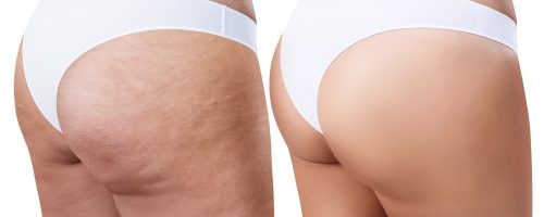 sculptra for cellulite Sculptra cellulite treatment