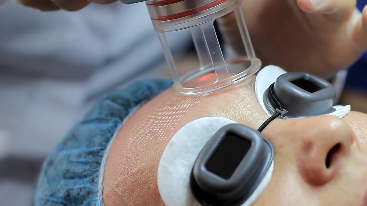 Fraxel Laser procedure