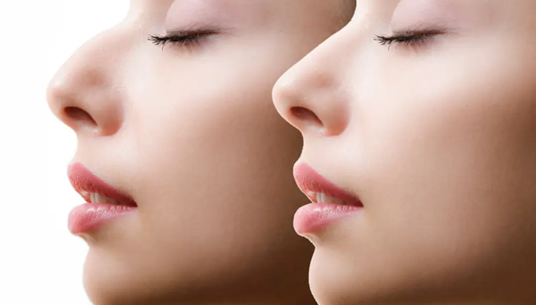 Non Surgical Rhinoplasty