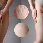 Cellulite is a complex, multifactorial process, what are the options?